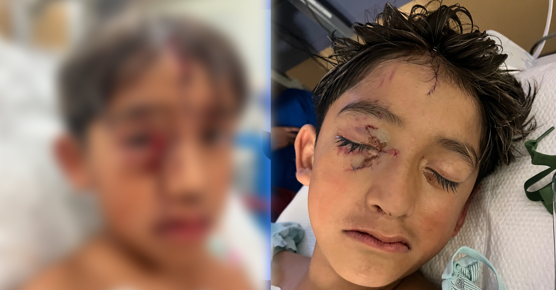 Ataque de Perros: Niño de 9 Años Herido por Pitbulls en Sunland Park Pide Ayuda a la Comunidad